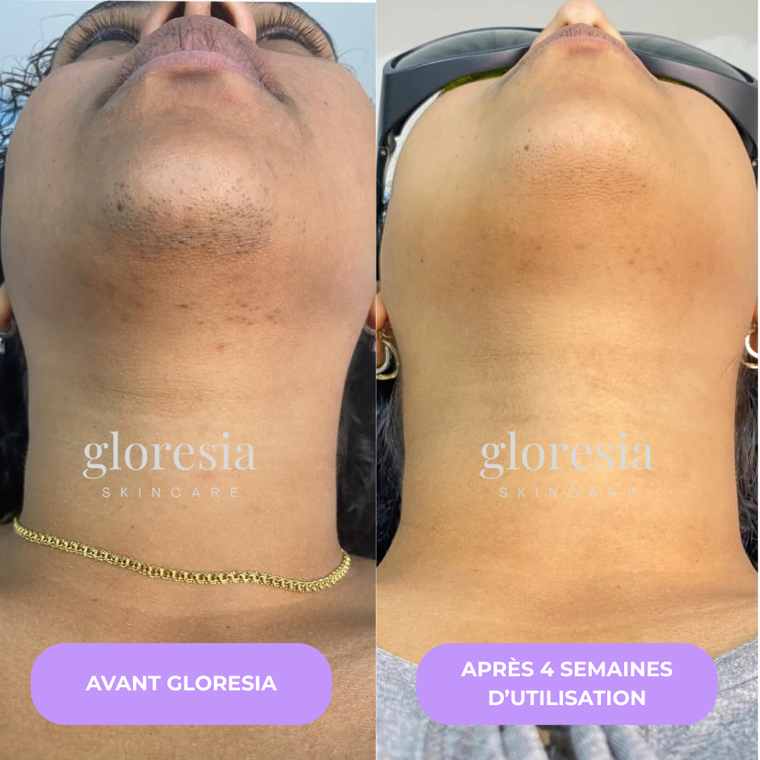 Gloresia™ – Sérum Anti-Repousse Naturel